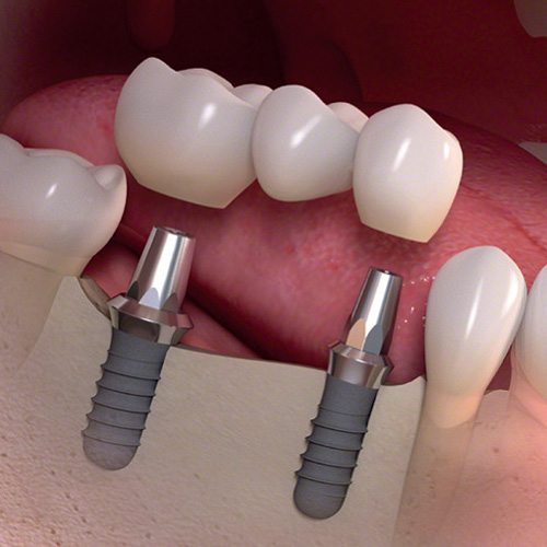 Implantat-Behandlung